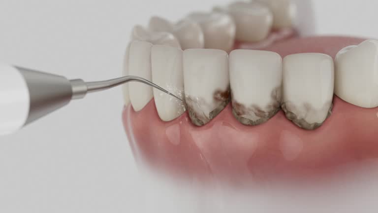 Trusted Wisdom Tooth Removal service in Goldenrod, FL - Dentist Open Now